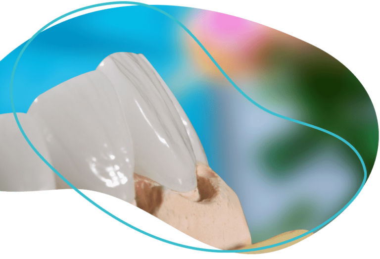 FULL SET Veneers in Mexico Affordable Cost [380 USD EACH]