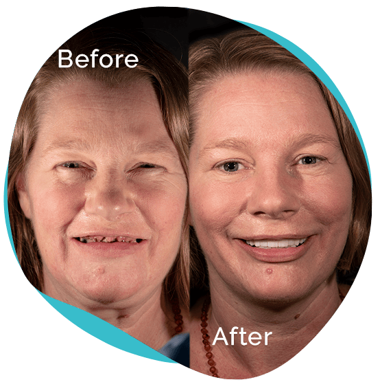 Snap on Dentures 6k USD FULL MOUTH DENTAL IMPLANTS