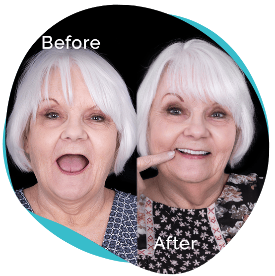 All on 4 dental implants before after cancun