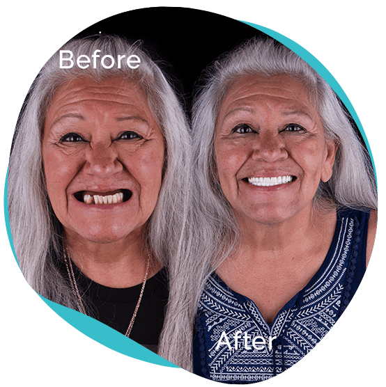All on 4 dental implants before after mexico