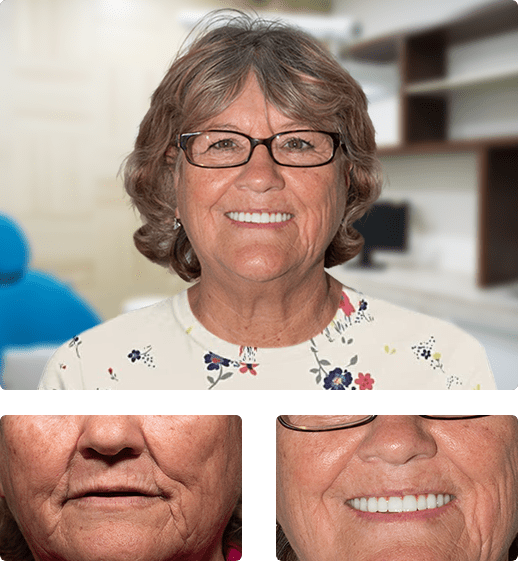 Snap On Dentures in Mexico