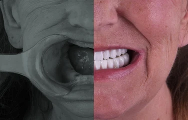 3-on-6-dental-implants-full-set-of-dental-implants 3 on 6 dental implants full set of dental implants