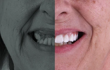 all-on-4-dental-implants-full-set-of-dental-implants all on 4 dental implants full set of dental implants