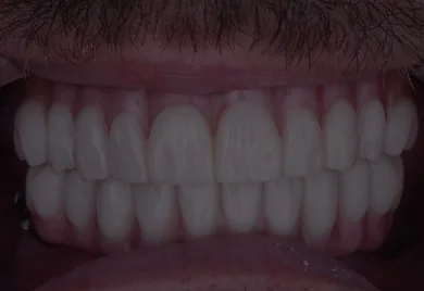 All on 4 dental implants- Calident Cancun dentist prices