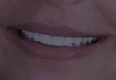 Dental veneers - Calident Cancun dentist prices
