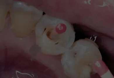 Root Canal - Calident Cancun dentist prices