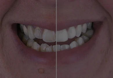 Teeth whitening - Calident Cancun dentist prices