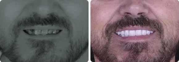 calident-cheapest-place-for-dental-implant-in-cancun-mexico-before-after calident cheapest place for dental implant in cancun mexico before after