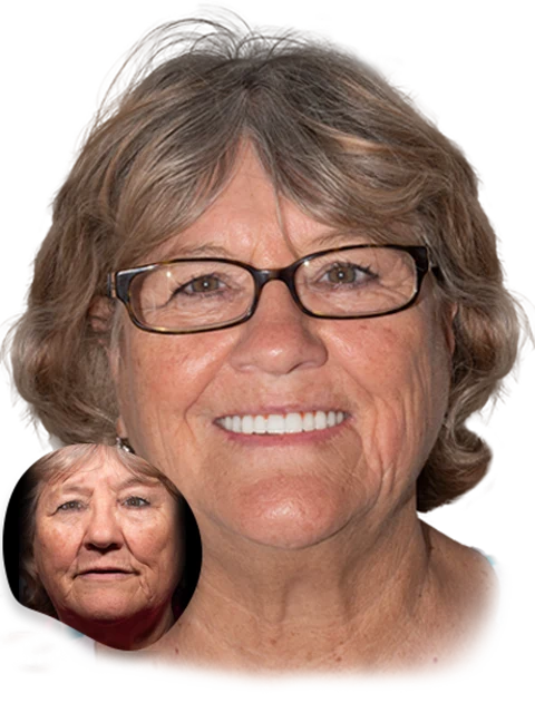 Calident Cancun patient before after