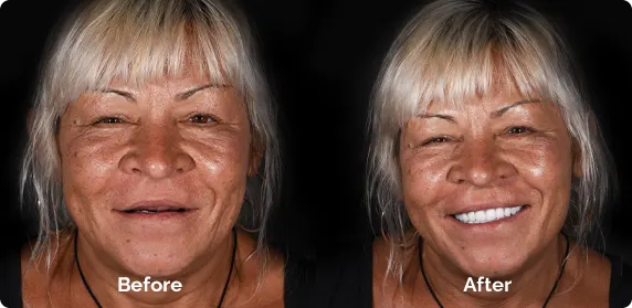 cancun-dental-implants-restorative-phase cancun dental implants restorative phase