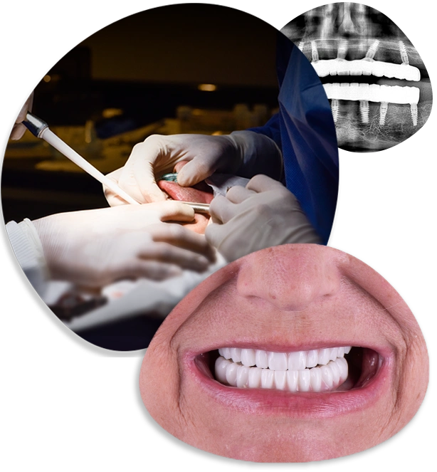 choosing-calident-for-cancun-dental-implants choosing calident for cancun dental implants