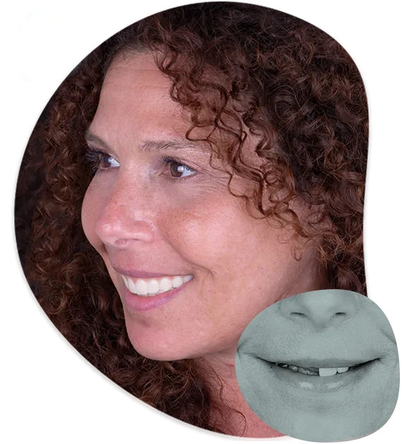 dental-implants-cancun-calident-lowest-price-in-mexico dental implants cancun calident lowest price in mexico