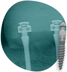 mini-dental-implants-available-types-of-dental-implants-in-mexico mini dental implants available types of dental implants in mexico