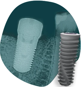 regular-dental-implants-available-types-of-dental-implants-in-mexico regular-dental-implants available types of dental implants in mexico