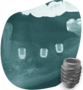 short-dental-implants-available-types-of-dental-implants-in-mexico short dental implants available types of dental implants in mexico