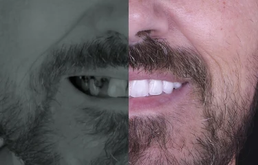 snap-on-dentures-full-set-of-dental-implants snap on dentures full set of dental implants