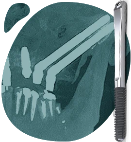 zygomatic-dental-implants-available-types-of-dental-implants-in-mexico zygomatic dental implants available types of dental implants in mexico